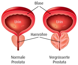 Benigne Prostatahyperplasie (BPH): Die gutartige Prostatavergrösserung (Foto: 123RF-111628947-andegro4ka) 
