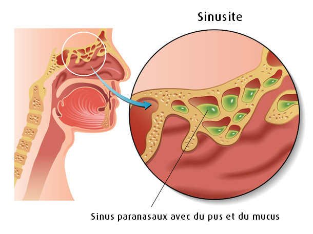 La sinusite : symptômes, causes, traitements et prévention | A.Vogel