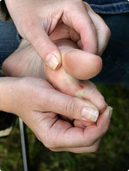 Des ampoules aux pieds Des ampoules aux pieds