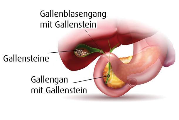 Gallensteine 