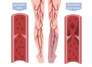 Vergleich gesunder und thromböser Venen