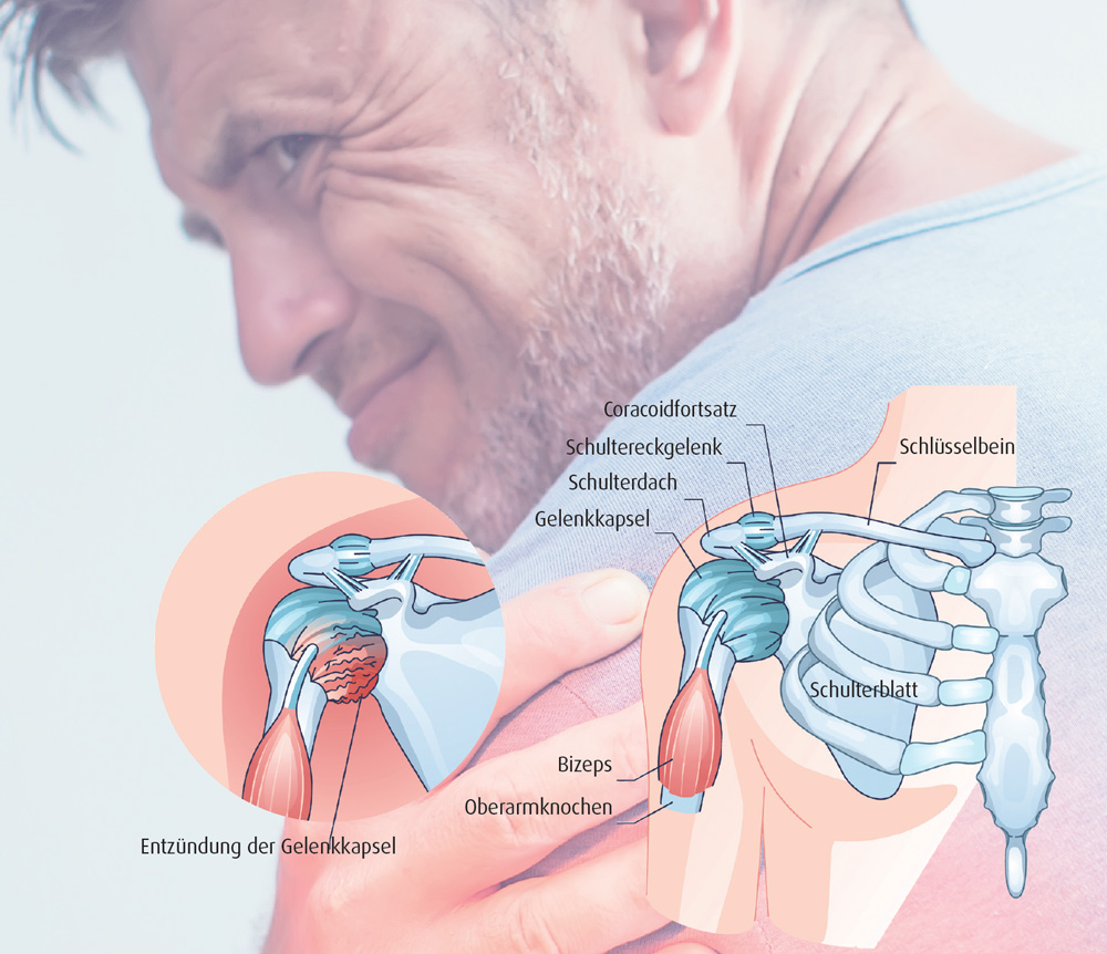 Frozen Shoulder: Fragiles Schultergelenk (Foto: Gesundheits-Nachrichten) Aufbau des Schultergelenks