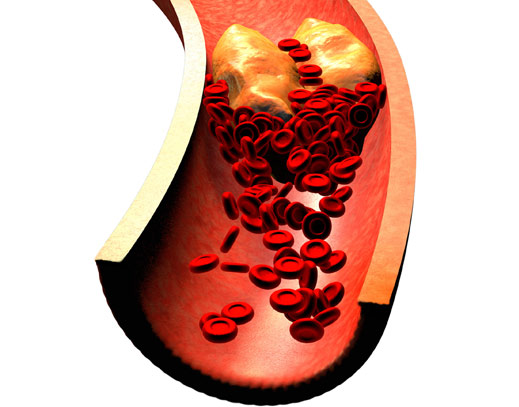 Cholesterin Statine gesunde Öle