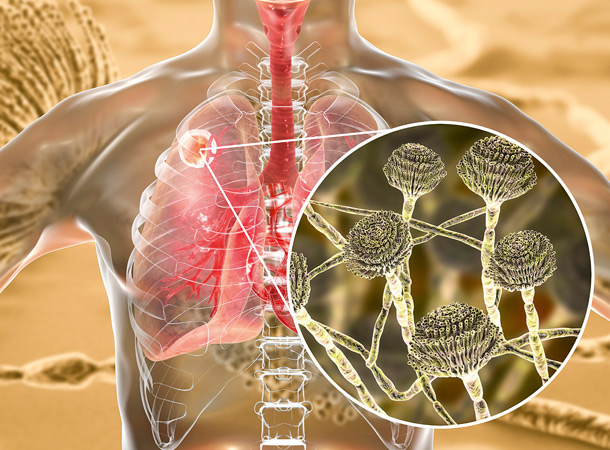 Grafik: Lunge und Pilz