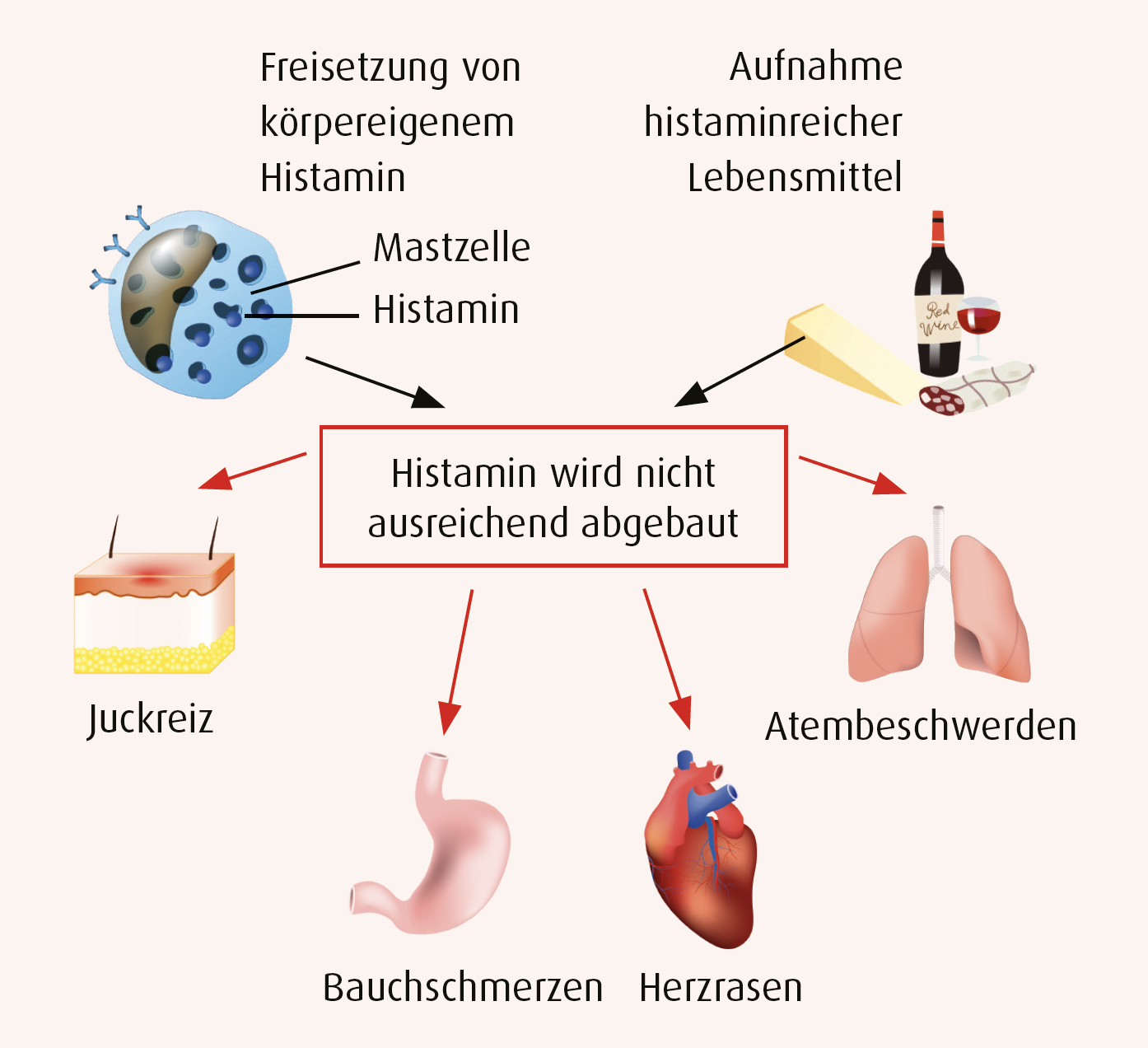 Infografik, die erklärt, wie eine Histaminreaktion im Körper abläuft.