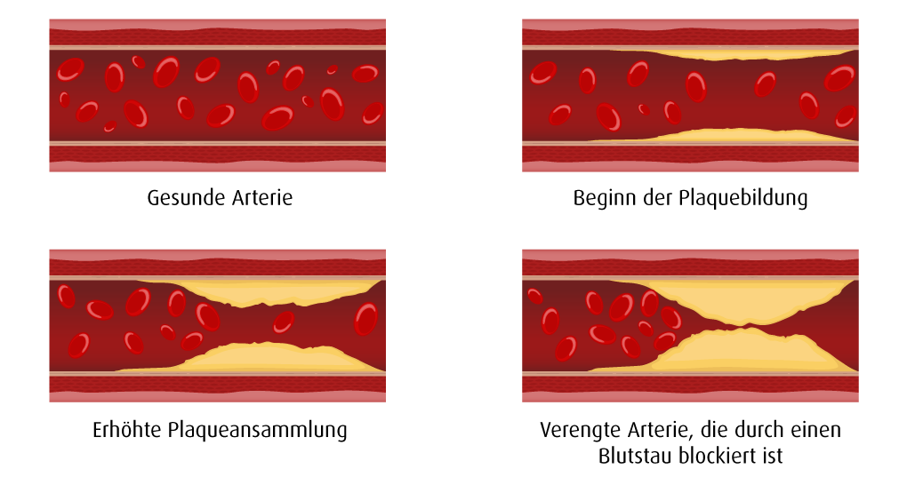 Man sieht den Verlauf der Krankheit. Vier Arterien sind abgebildet. Eine gesunde Arterie, eine mit beginnender Plaquebildung, eine mit starker Plaquebildung und als letztes eine verengte Arterie in der das Blut staut.
