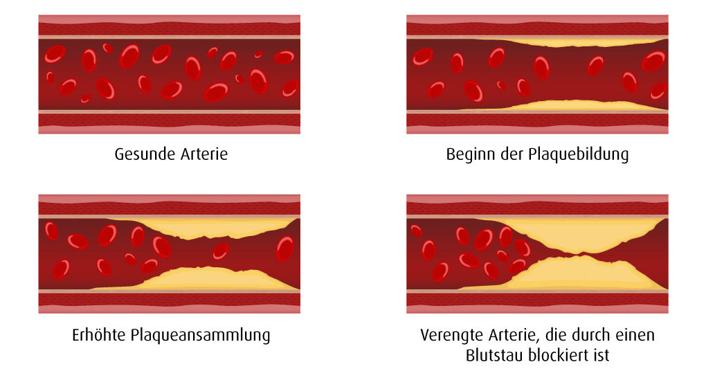 Arteriosklerose, Arterien im Querschnitt (Illustration: 123RF, cono0430) Man sieht den Verlauf der Krankheit. Vier Arterien sind abgebildet. Eine gesunde Arterie, eine mit beginnender Plaquebildung, eine mit starker Plaquebildung und als letztes eine verengte Arterie in der das Blut staut.
