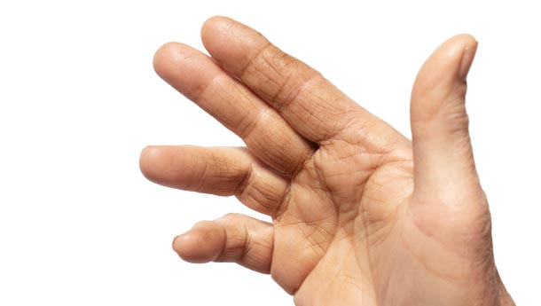 Eine betroffene Hand wird gezeigt. Erste Verformungen des Kleinen Fingers und dem daneben sind ersichtlich.