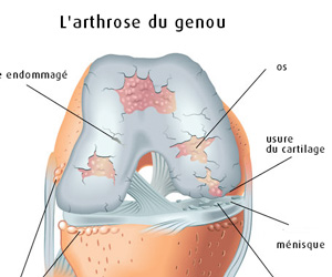 arthrose