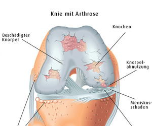Kniegelenk-Arthrose