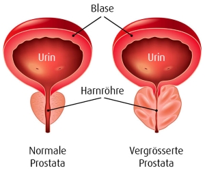 prostatitis hausmittel