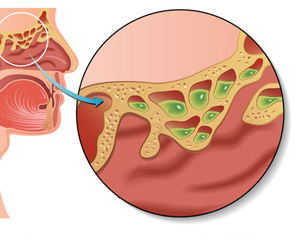 Inflammation des sinus frontaux