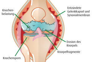 Infografik: Vergleich gesundes und arthrose krankes Knie (Illustration: 123RF, normaals)