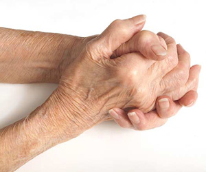 Arthrite rhumatoïde : Affections rhumatismales inflammatoires