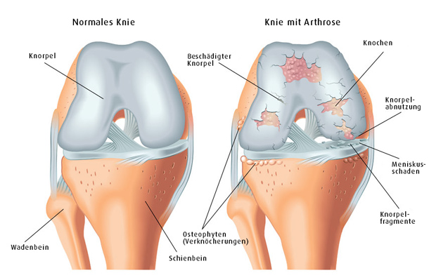 Kniegelenk Arthrose