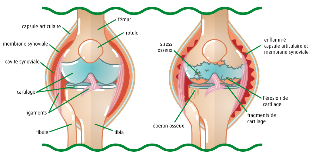 Infographie: Comparaison entre un genou sain (gauche) et arthrosique (droite)