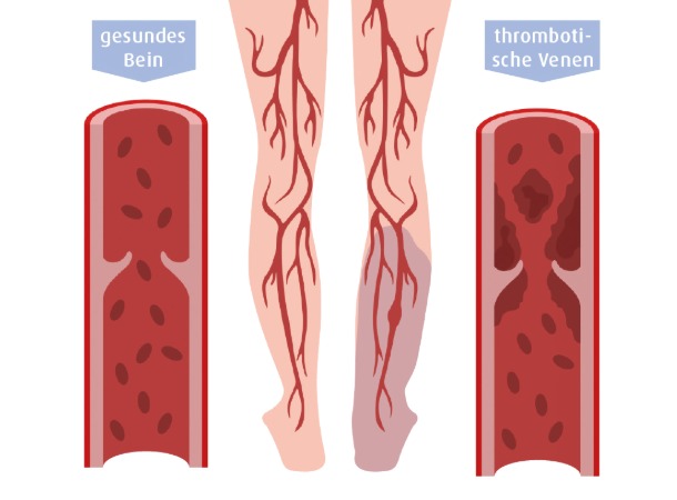Vergleich gesunder und thromböser Venen