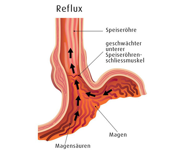 Refluxbeschwerden 