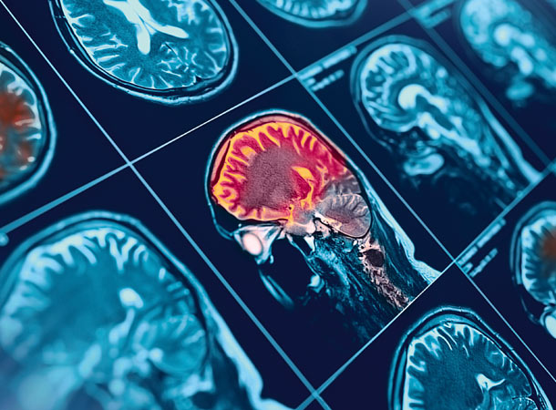 Ursachenforschung ist wichtig für den Behandlungserfolg (Foto: 123RF/sudok1) Hirnscan