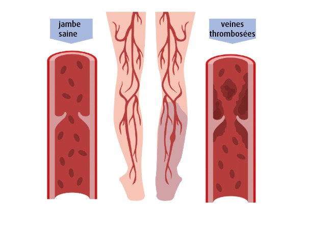 Veines (123RF/a7880s) veines
