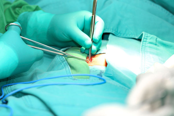Man sieht die Operation eines Leistenbruchs. Die Chirurgin arbeitet gerade mit einer Pinzette und einer Schere an einer offenen Stelle an der Leiste..