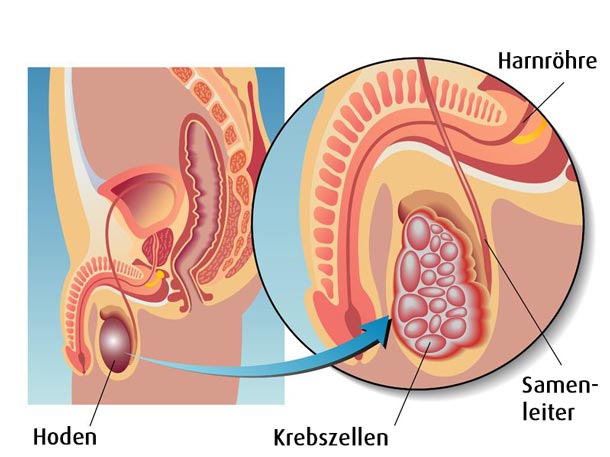 Hodenkrebs
