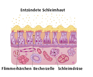 Entzündete Nasenschleimhaut