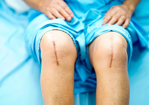 Les cicatrices peuvent être considérablement influencées en choisissant une coupe optimale et un matériau de suture parfait.