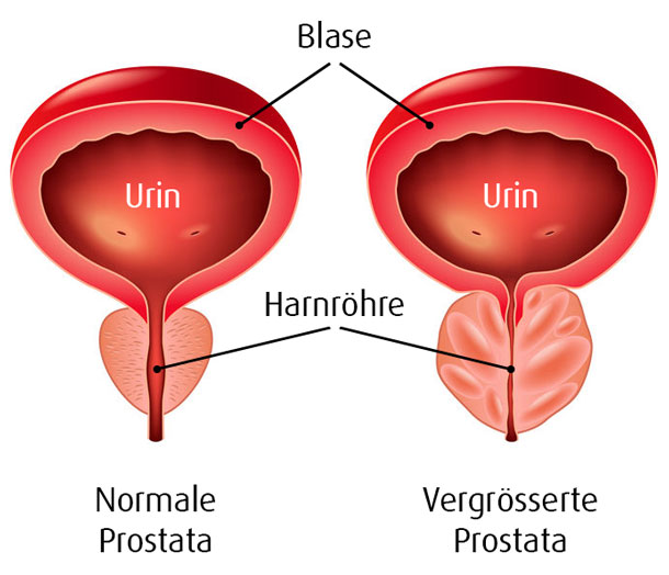 benigne prostatahyperplasie( bph) Prostatitis magas