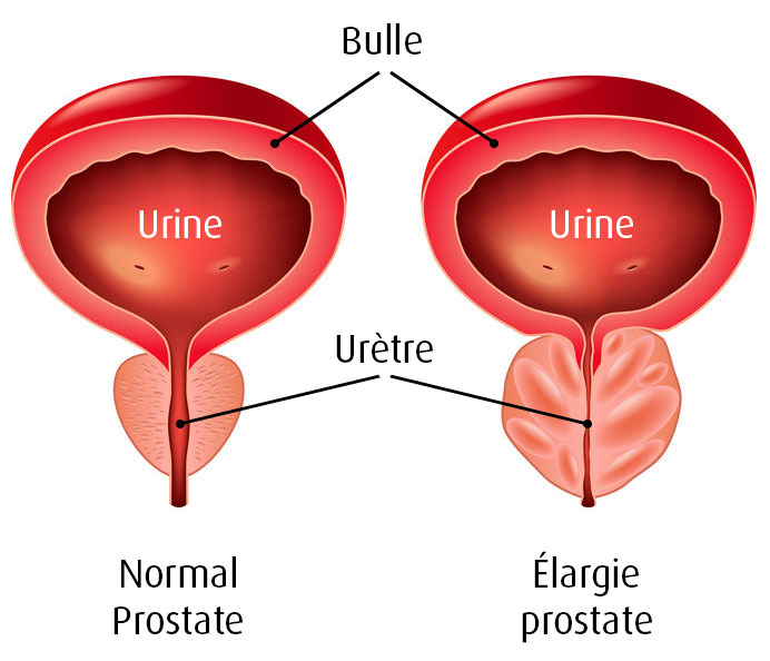 cu prostatita cronică, prostata nu este mărită inflamare prostata