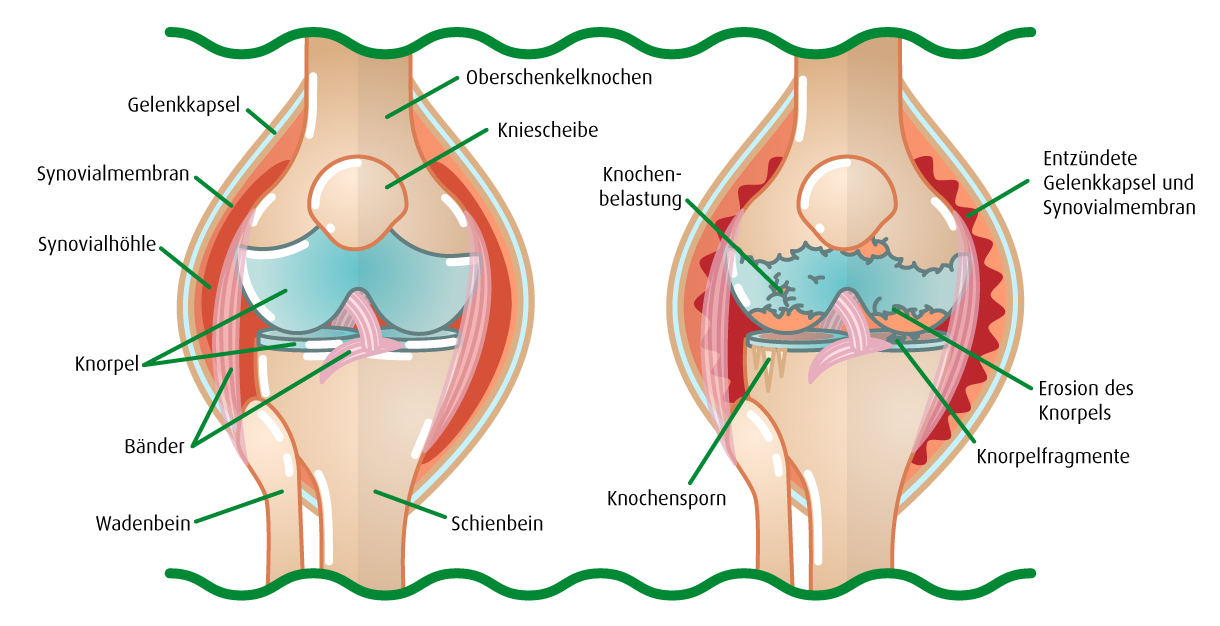 Infografik: Vergleich gesundes und arthrose krankes Knie (Illustration: 123RF, normaals)