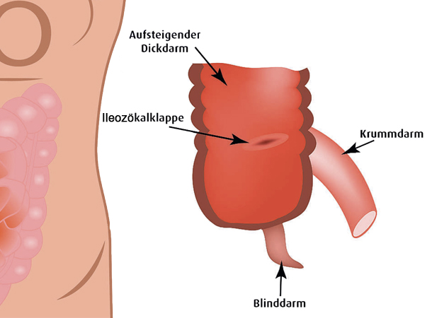 Vektografik Ileozökalklappe